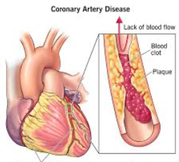 Innovative Treatments for Coronary Artery Disease:...