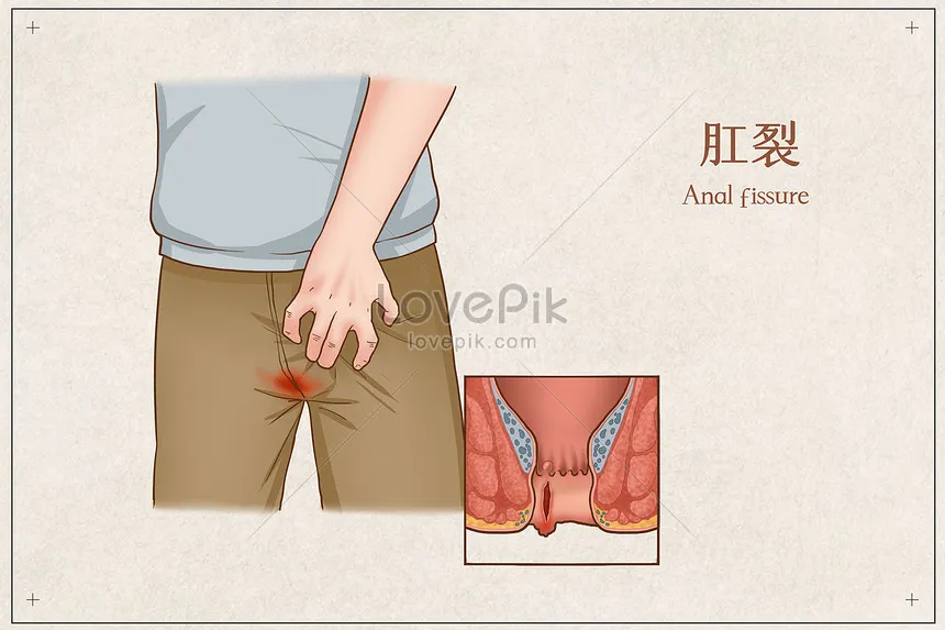 Anal Fissure-
Anal Fissure is a linear tear over t...