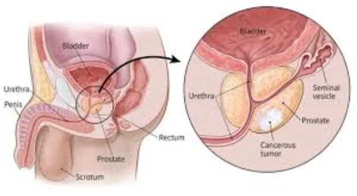 Navigating Prostate Health: Expert Solutions in Th...
