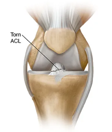 Expert Treatment for Ligament Injuries by Dr. Rake...