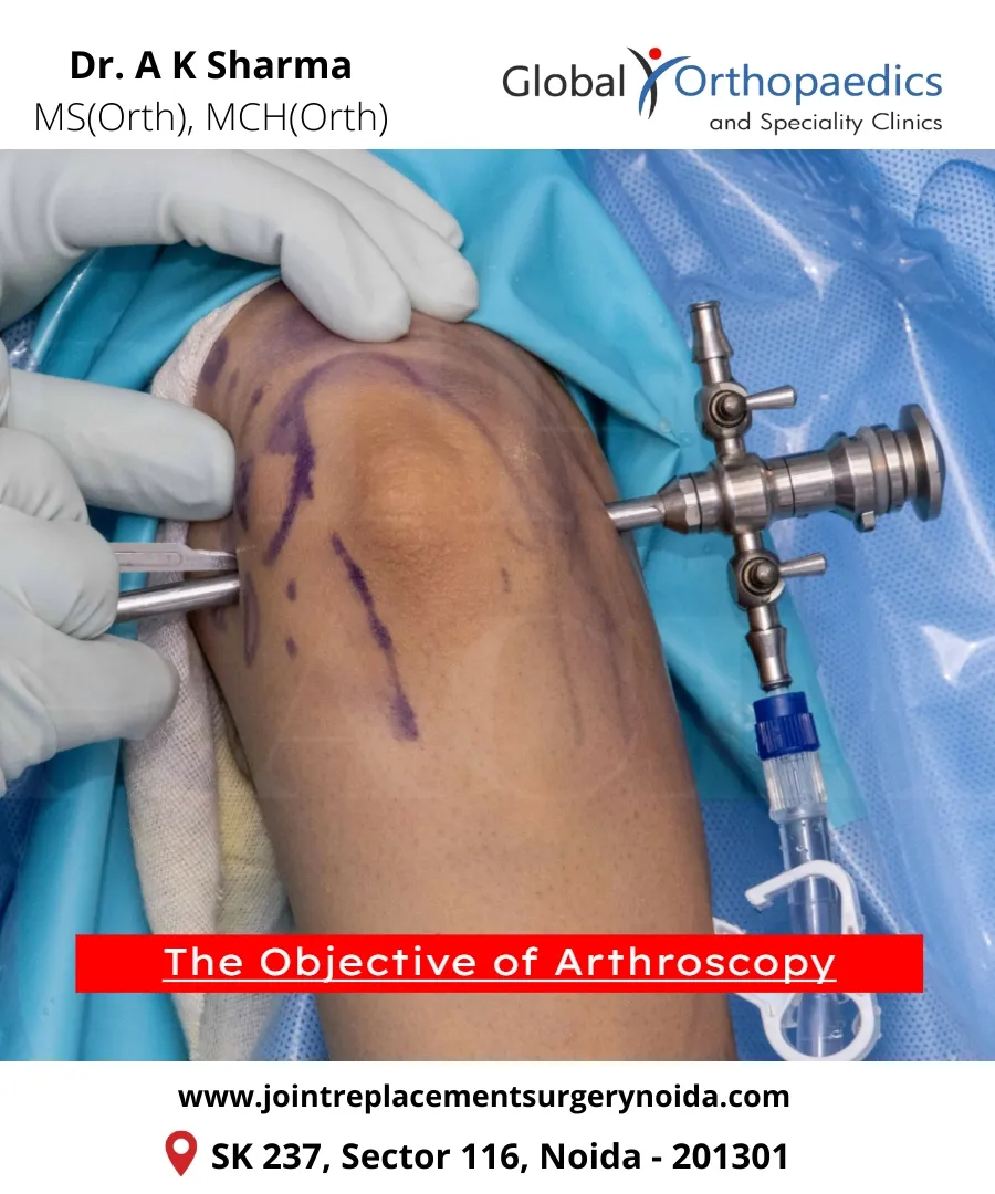Best Arthroscopy Surgeon in Delhi NCR
In orthoped...