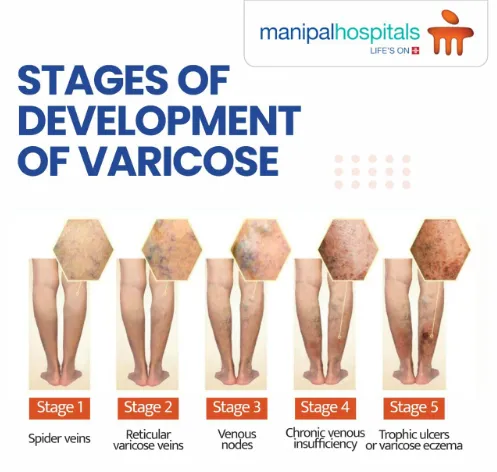 Varicose veins is a slowly progressing disease. It...