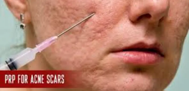 PRP Therapy for Acne and Acne Scar: Gindodia Hospi...