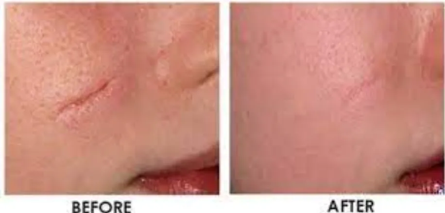 Say Goodbye to Scars: Expert Solutions at Kimaya S...