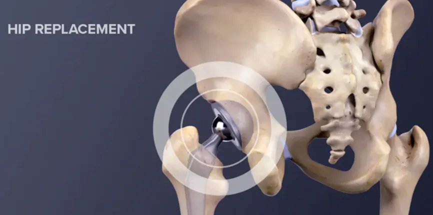 Best Doctor for Hip Replacement in Nashik: Dr. Rak...