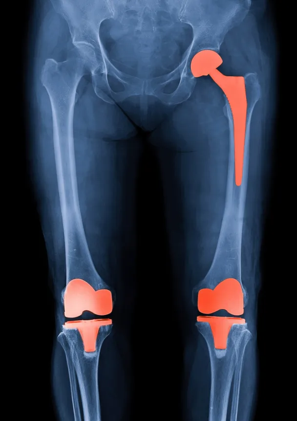 Revolutionizing Knee and Hip Replacement: Anand Or...
