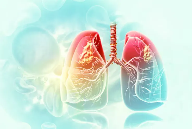 Expert Lung Care at Galaxy Hospital Best Lungs Doc...