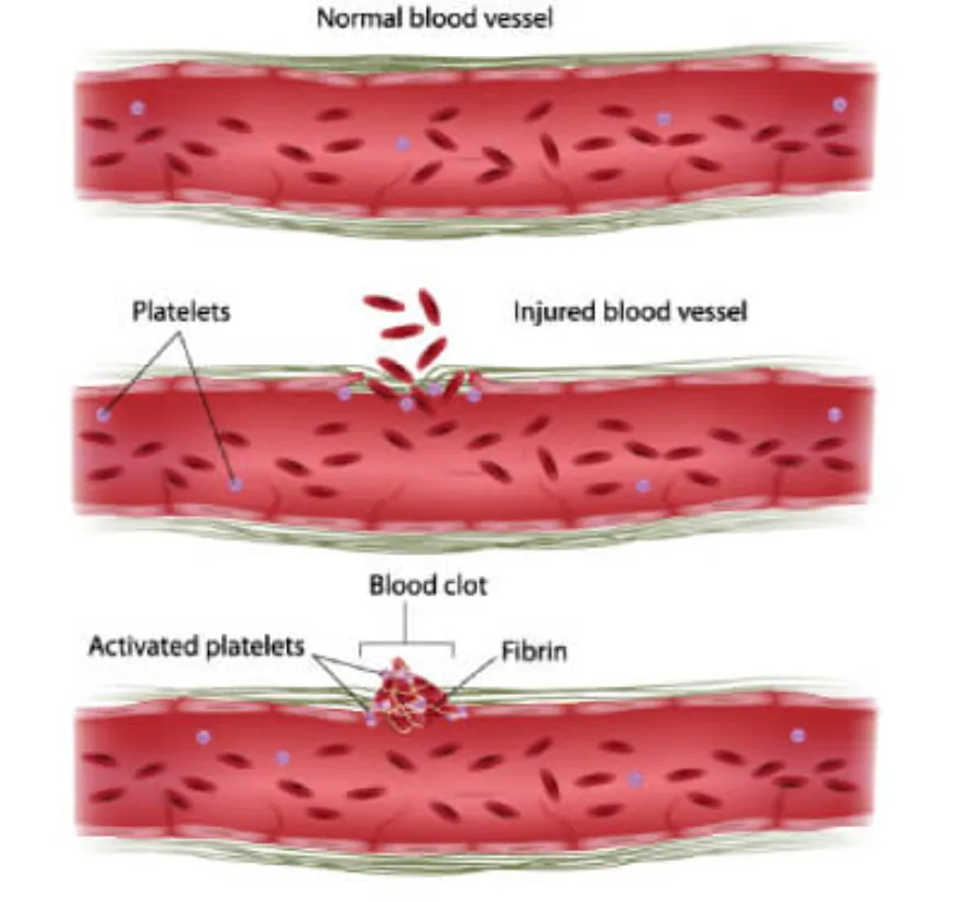 Managing Bleeding Disorders: Expertise by Dr. Atis...