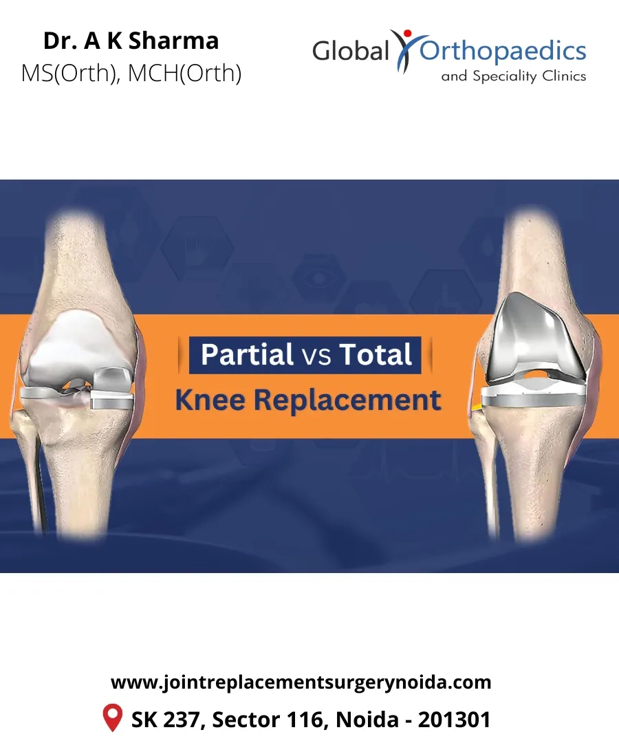 Partial vs. Total Knee Replacement: Choosing the R...