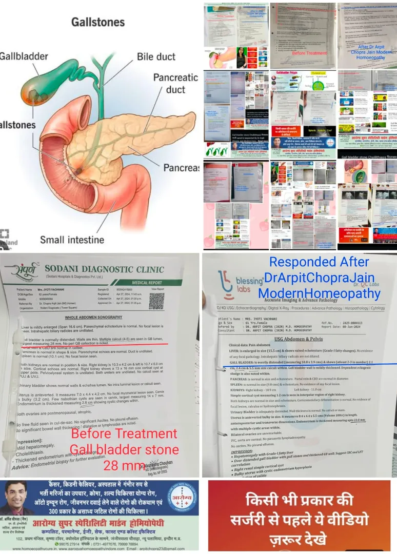 Gall Bladder Stone 28 mm & Bulky Uterus 26 mm Resp...