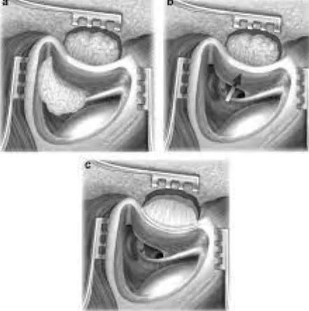 Exploring Posterior Tympanotomy: A Path to Clear H...