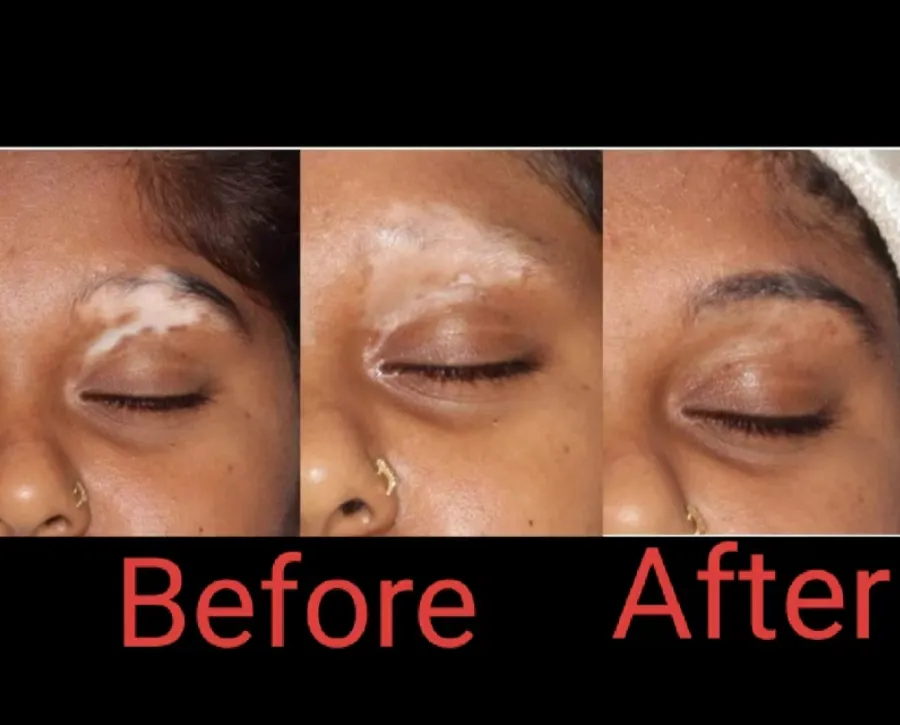 PRP Therapy for Vitiligo: Advanced Treatment at Gi...
