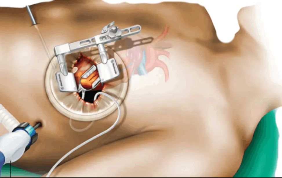 Revolutionizing Surgery: MICS CABG in Nagpur MICS ...