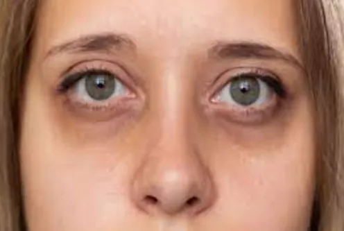 Say Goodbye to Dark Circles with Expert Treatment ...