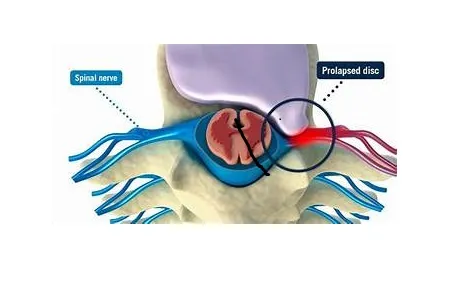 A disc bulge refers to a condition where one of th...