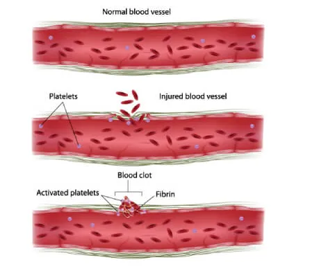 Comprehensive Care for Bleeding Disorders by Dr. A...