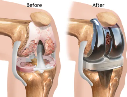 Knee Replacement Comprehensive Knee Replacement Su...