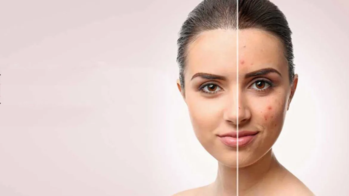 Acne Treatment in West Delhi
Depending on the sev...