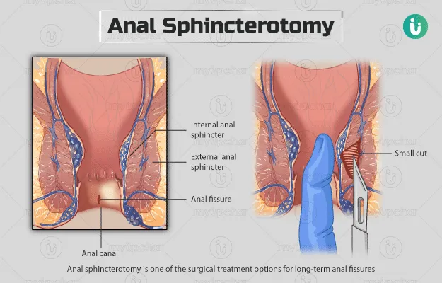 Sphincterotomy simply means dividing the sphincter...