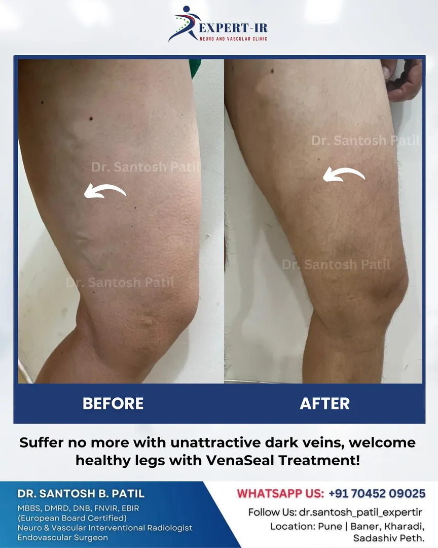 👉 Are you dealing with unattractive thick dark vei...
