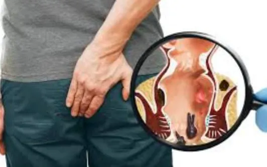 Best Piles Doctor in Pune: Expert Care at Dr. Phap...