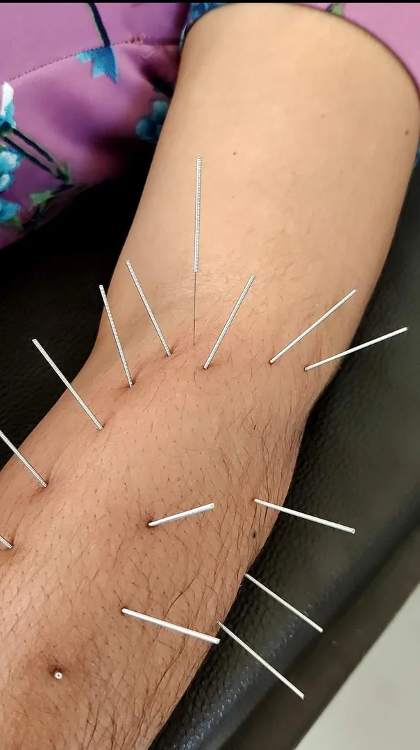 Dry needling and acupuncture are both techniques i...