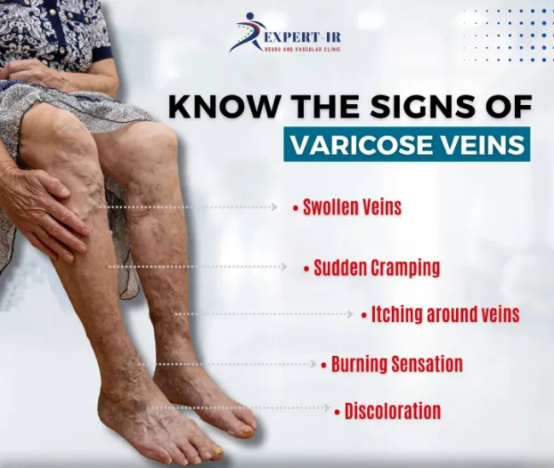 Varicose veins can significantly impact your comfo...