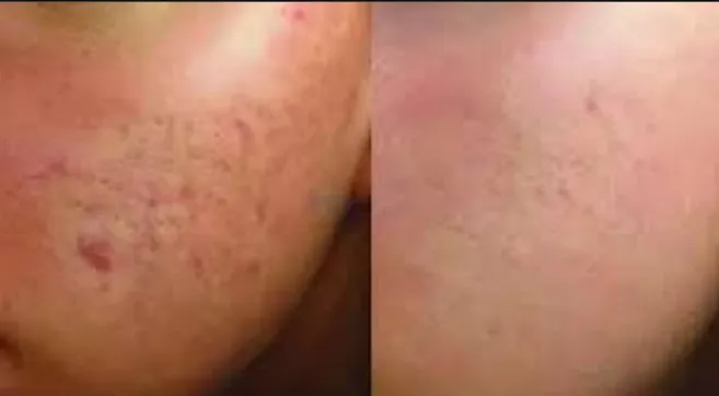 PRP Therapy for Acne and Acne Scar: Effective Trea...