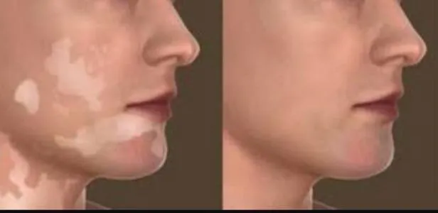 Vitiligo (White Patches) Treatment at Gindodia Hos...