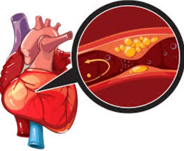 Managing Coronary Artery Disease at SR Heart Clini...