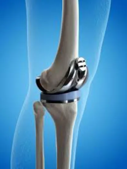 Knee Joint Replacement Specialist in Rajkot Advanc...