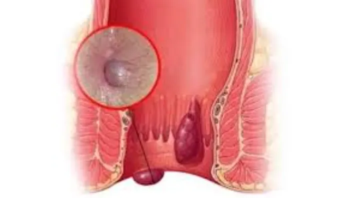Best Piles Doctor in Kalyan for Your Comprehensive...
