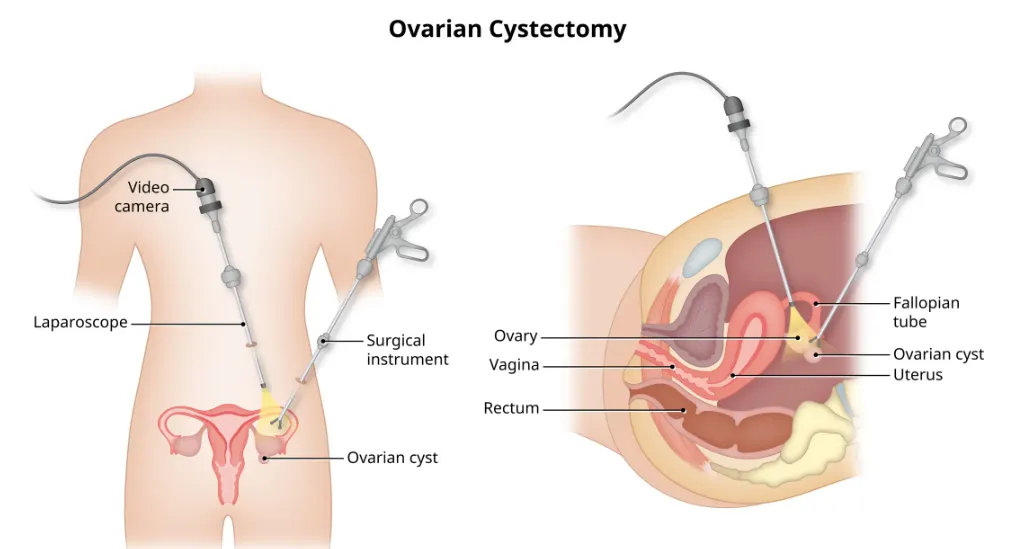 Ovarian Cystectomy Surgery Services at Jijai Women...
