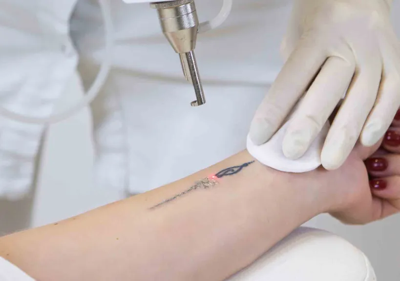Effective Tattoo Removal at Dr. Richa's Unique Cli...