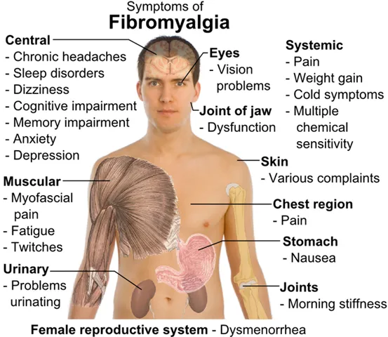 FIBROMYALGIA SYNDROME AND MYALGIC ENCEPHALOPATHY/C...