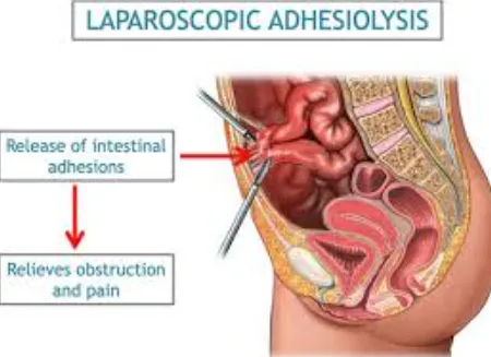 Laparoscopic Adhesiolysis Surgery Specialists in T...