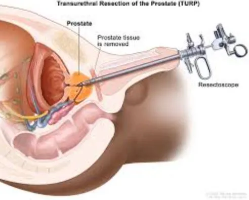 Prostate Treatment in Thane: Expert Care for Optim...
