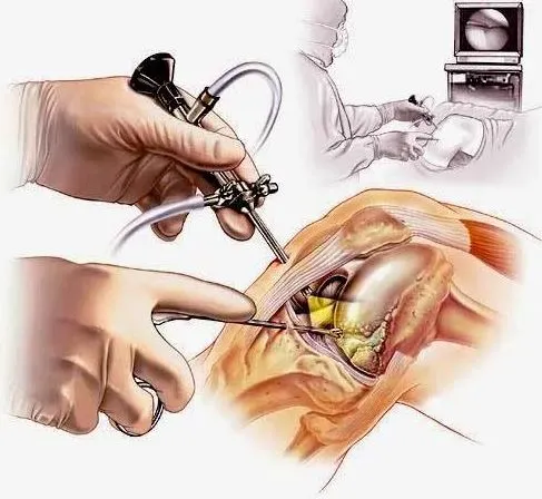 Arthroscopy: Advanced Joint Care in Nashik Arthros...