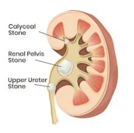 Best Kidney Stone Treatment in Thane: Choose Quali...