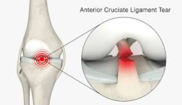 ACL Tear Treatment by Dr. Rakesh Gosavi in Nashik ...