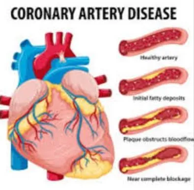 Managing Coronary Artery Disease Coronary Artery D...
