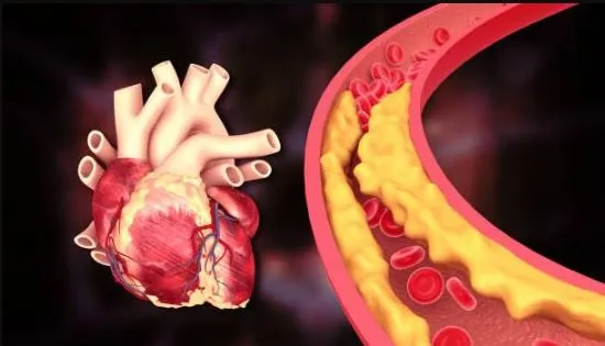 Heart Block: What You Need to Know Heart blockages...