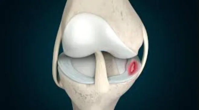 Medial Meniscus Tear Care in Nashik with Dr. Rakes...