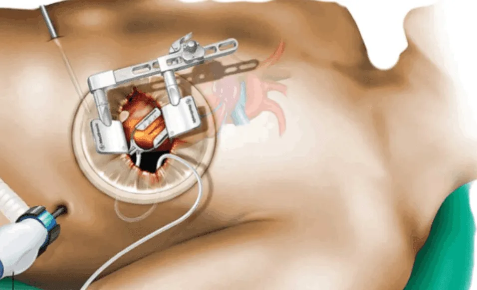 Completion Angiography for MICS CABG at Dr. K G De...