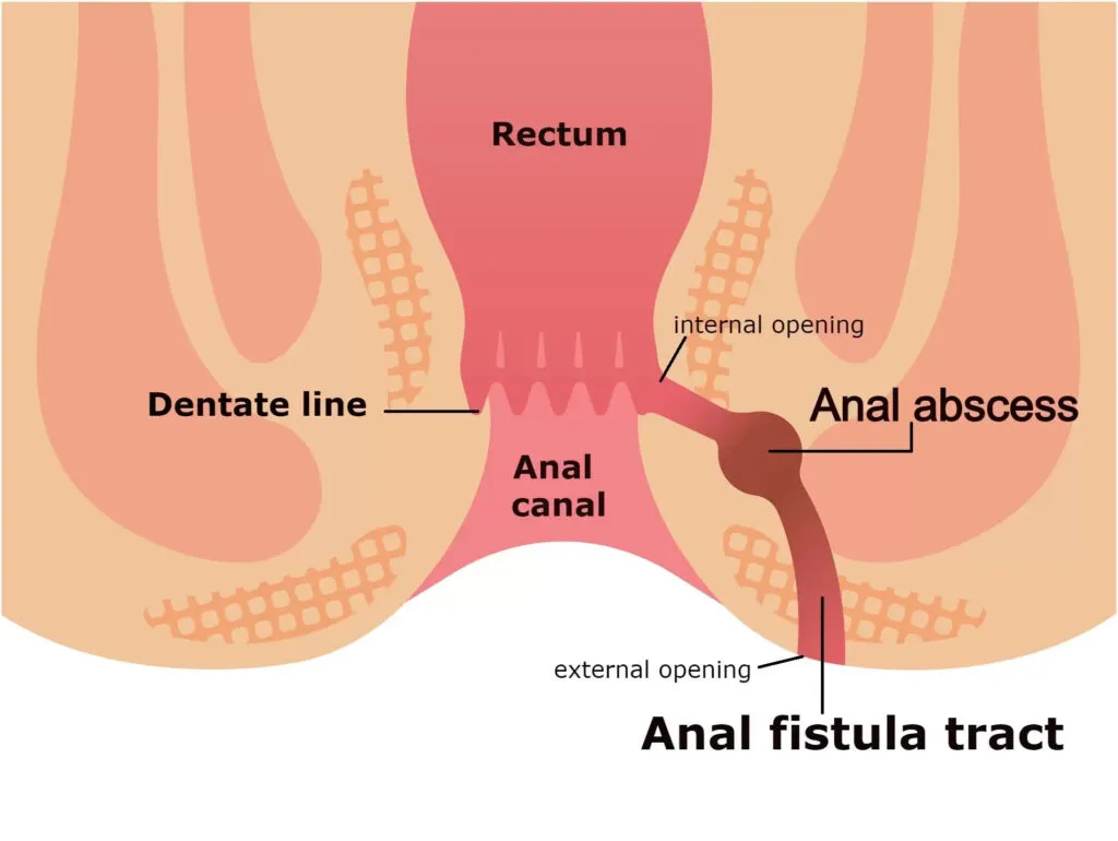The symptoms of an anal abscess and an anal fistul...