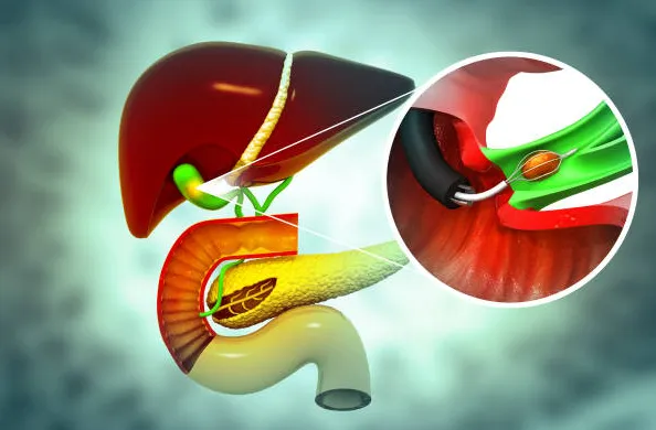 Best Gallstone Removal Doctor in Kalyan When it co...