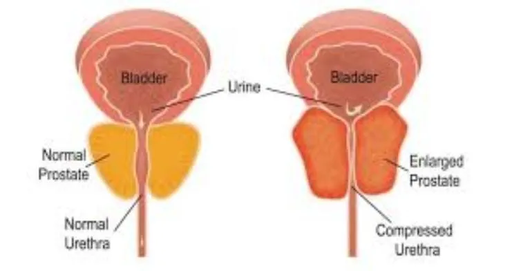 Prostate Treatment in Thane: Expert Care for Men’s...