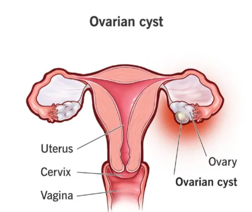 Ovarian Cyst Treatment at Shree Homoeopathic Clini...
