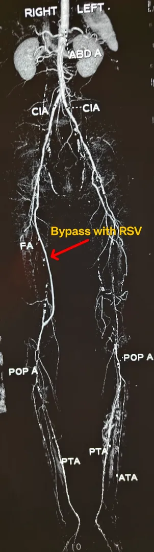 he was treated with an open bypass using his own n...