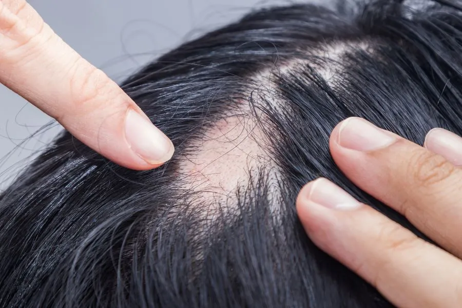 Understanding Alopecia Areata: Causes, Symptoms, a...